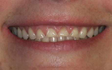 Crown Lengthening Case 1 Before