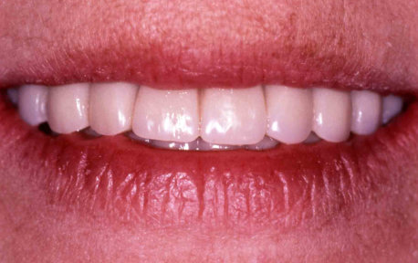 Full Mouth Reconstruction Case 1 After