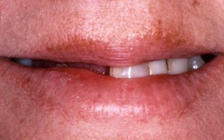 Full Mouth Reconstruction Case 1 Before