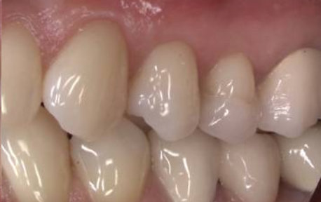 Gum Grafting Case 1 After