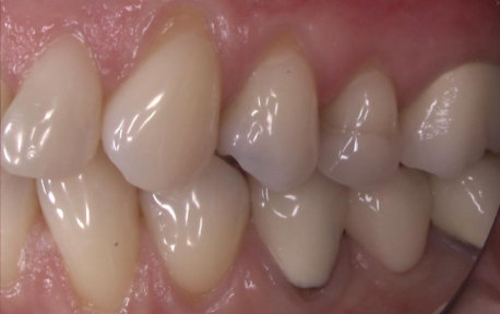 Gum Grafting Case 1 Before