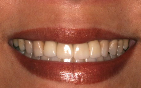 Crown Lengthening Case 2 After