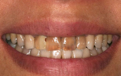 Crown Lengthening Case 2 Before