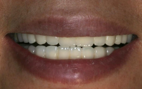 Full Mouth Reconstruction Case 2 After