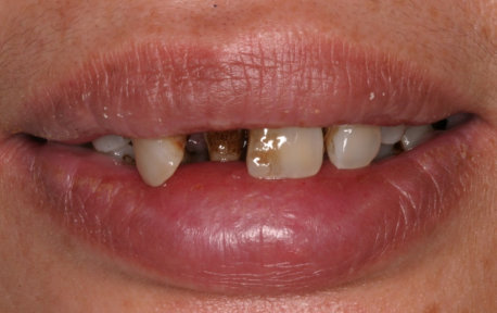 Full Mouth Reconstruction Case 2 Before