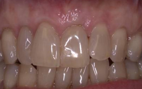 Gum Grafting Case 2 After