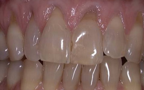 Gum Grafting Case 2 Before