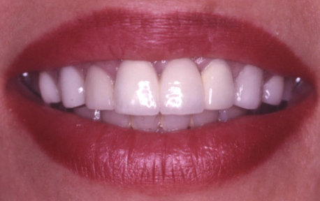 Crown Lengthening Case 3 After