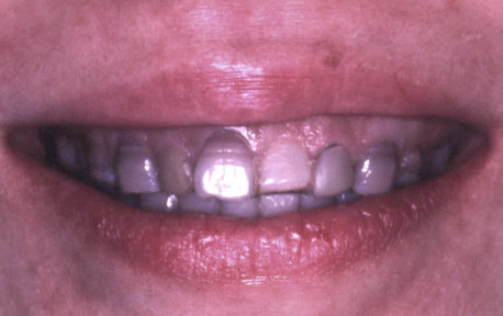 Crown Lengthening Case 3 Before