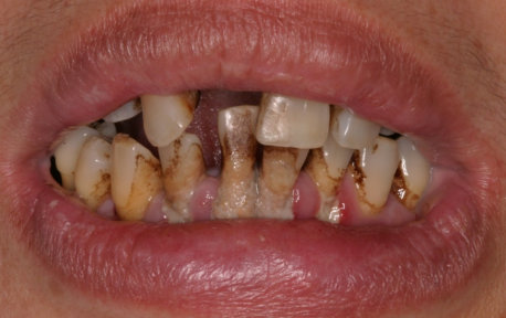 Full Mouth Reconstruction Case 3 Before