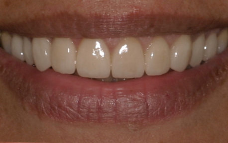 Crown Lengthening Case 4 After