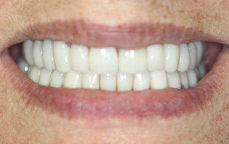Full Mouth Reconstruction Case 4 After