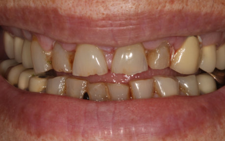Full Mouth Reconstruction Case 4 Before