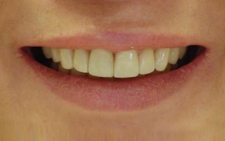 Full Mouth Reconstruction Case 5 After