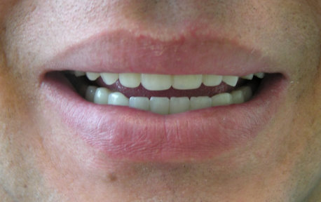 Full Mouth Reconstruction Case 6 After