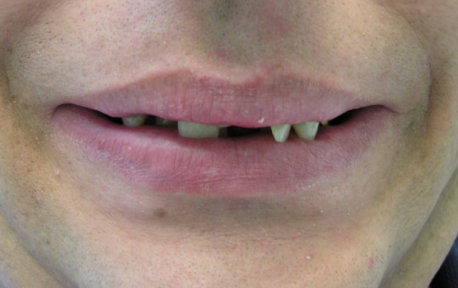 Full Mouth Reconstruction Case 6 Before