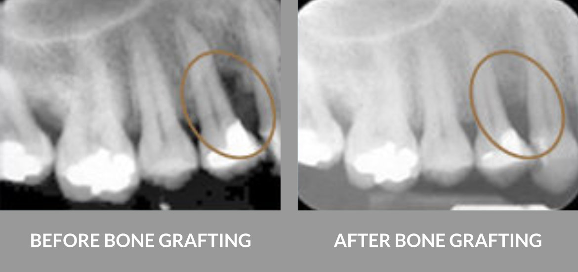 Bone Grafting Procedure