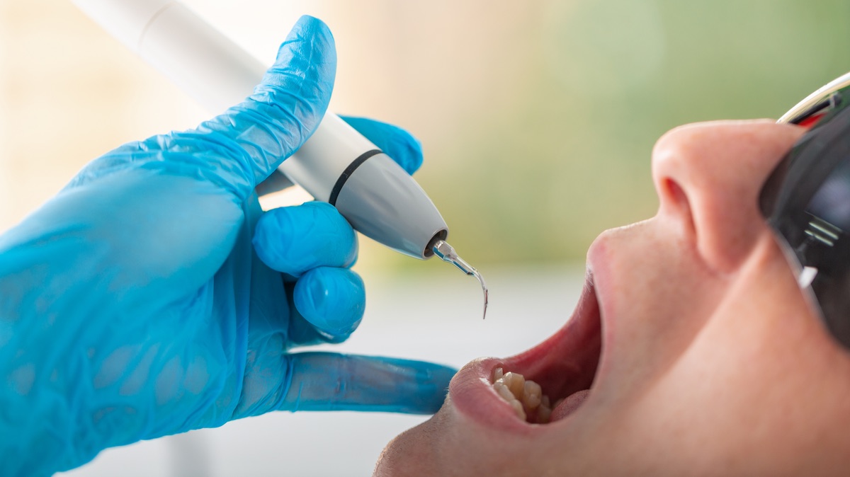 Ultrasonic scaling equipment used for deep cleaning at Main Line Dental Implant Center