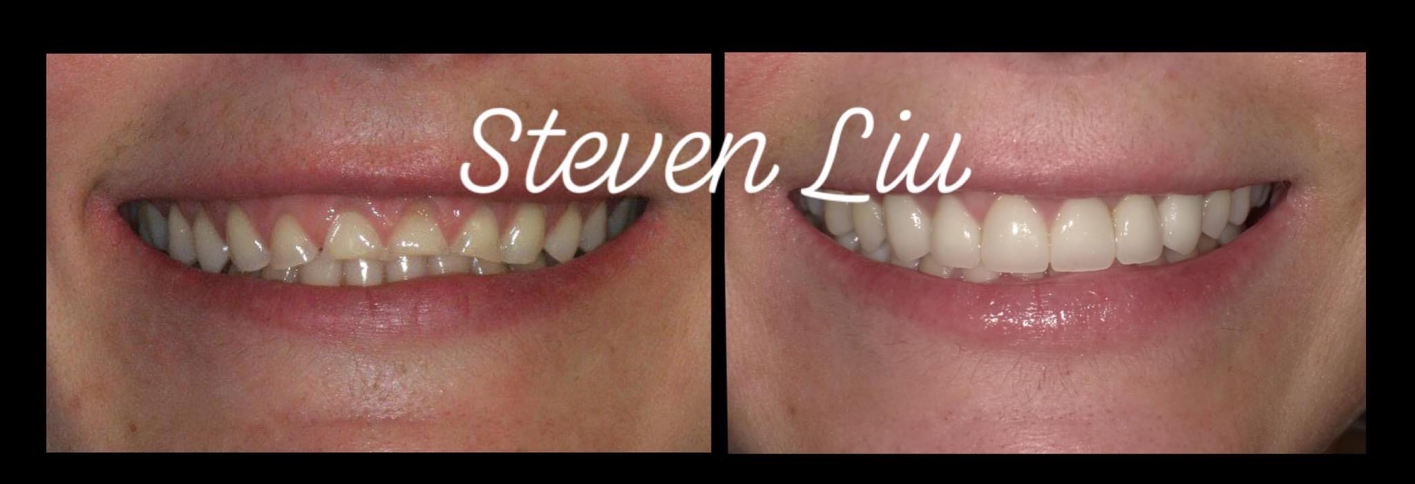 Cosmetic Crown Lengthening Case 2