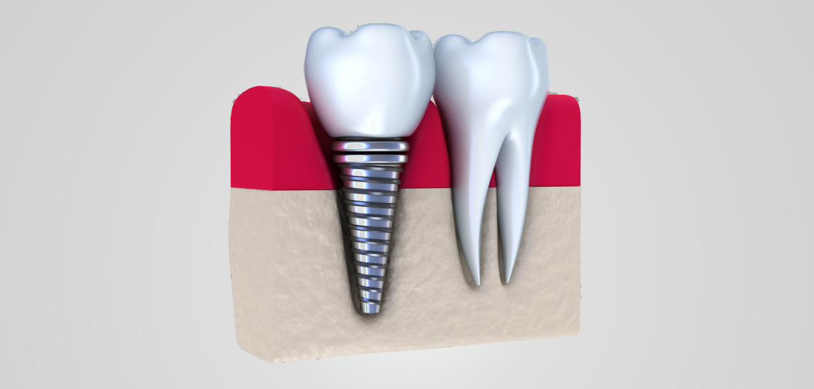 Dental Implants