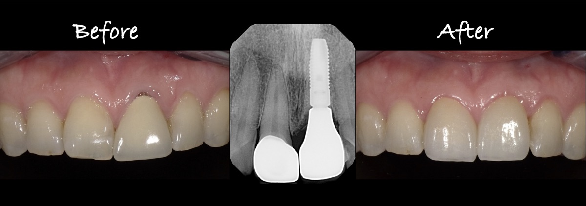 Regenerative periodontal therapy case at Main Line Dental Implant Center, Berwyn PA