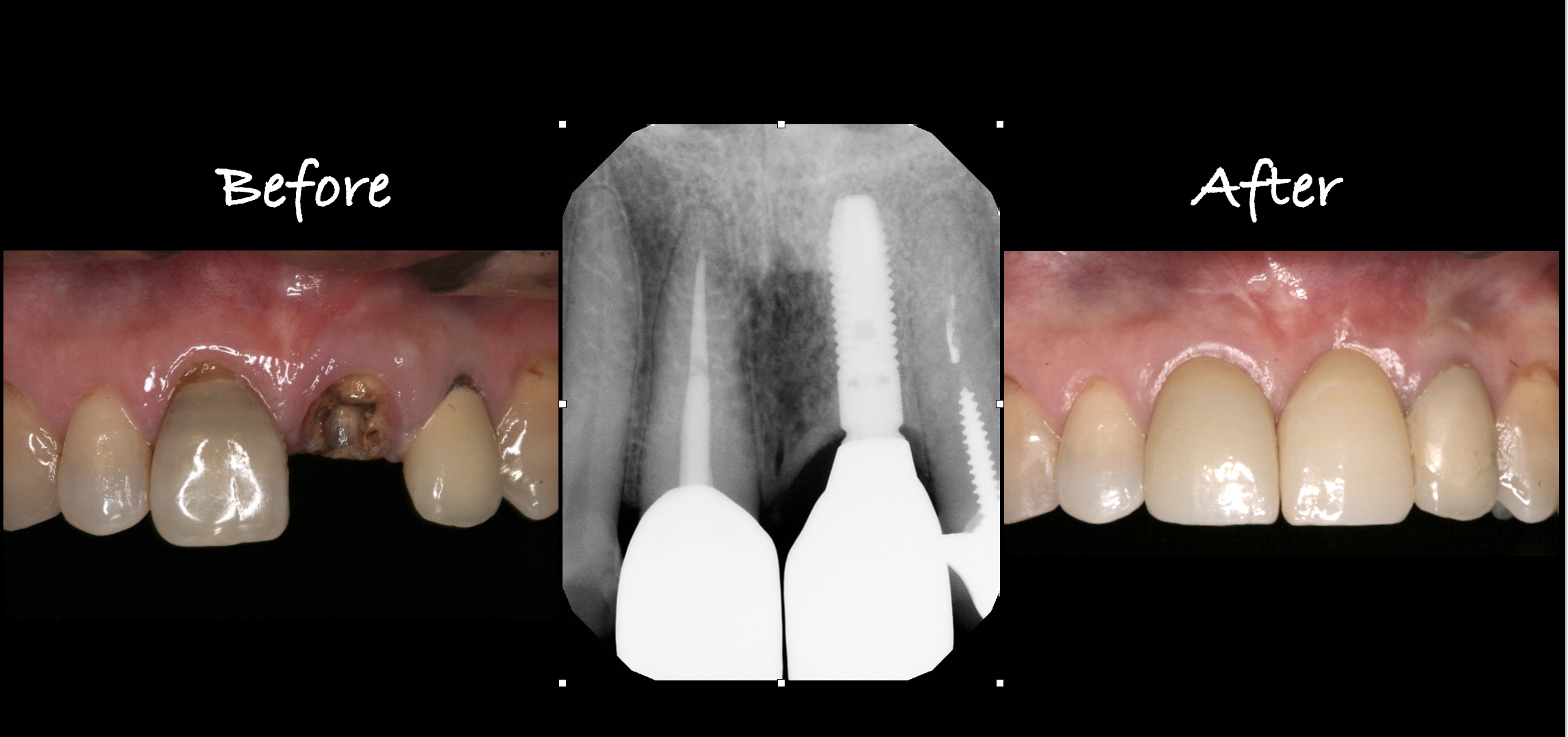 Implant Therapy Case 2