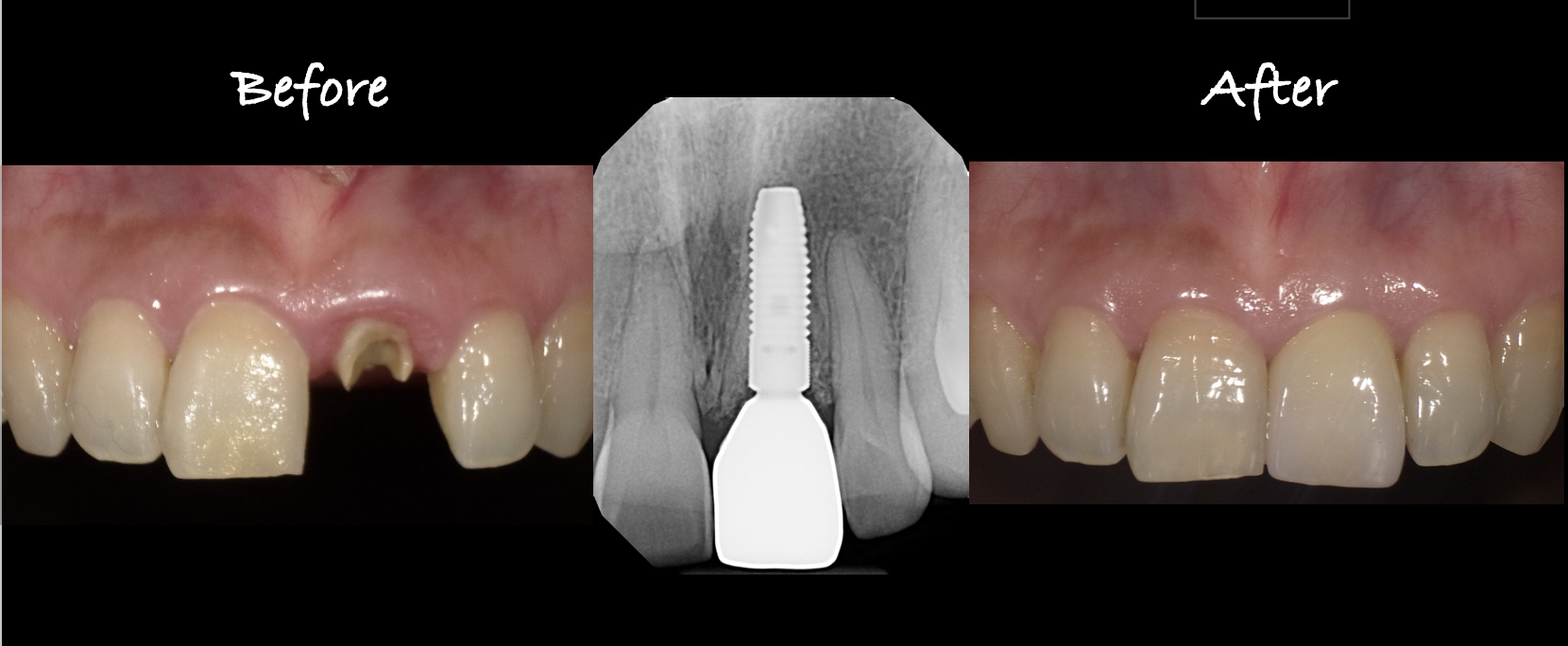 Implant Therapy Case 3