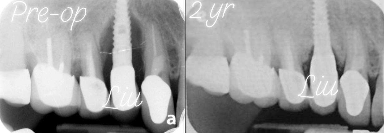 Peri-Implantitis Treatment