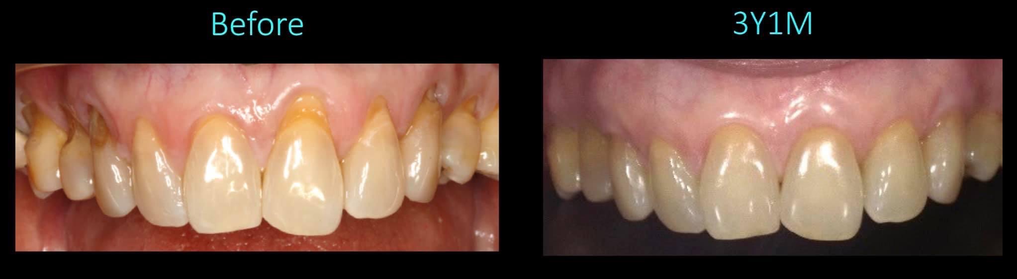 Pinhole Gum Rejuvenation Case 1