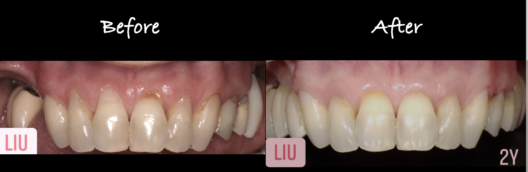 Pinhole Gum Rejuvenation Case 2