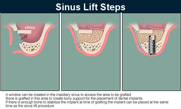 Sinus Augmentation Procedure